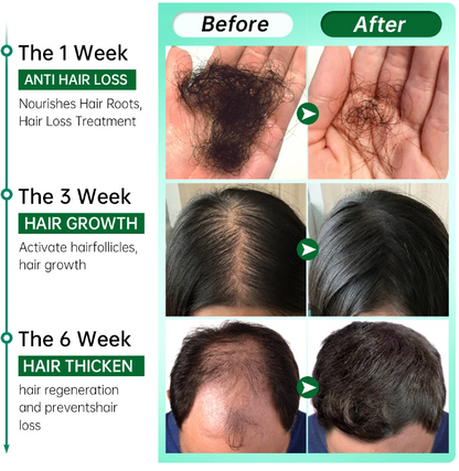 PURC Rosemary Oil Hair Growth - Anti Hair Loss